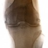 upload/articles/thumbs/170712040118Rheumatoid arthritis of the knee.jpg
